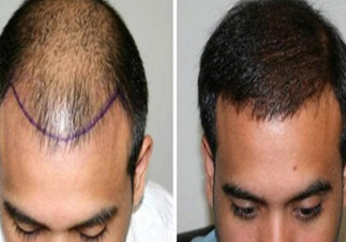 best hair transplantation in vijayawada